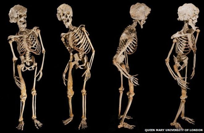 The Elephant Man’s skeleton Britain